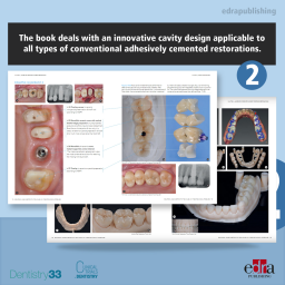 Dental Solutions - Adhesive Restoration - Marco Veneziani - Dental Restoration Techniques - Book Extract