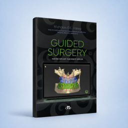 GUIDED SURGERY Making implant placement simpler - implant - SURGERY - Nicholas G.C. Fahey